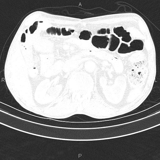 Ampullary adenocarcinoma (Radiopaedia 86093-102033 Axial lung window 62).jpg