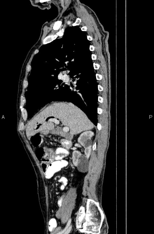 Ampullary adenocarcinoma (Radiopaedia 86093-102033 E 31).jpg