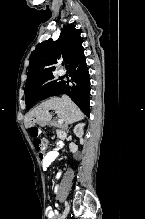 Ampullary adenocarcinoma (Radiopaedia 86093-102033 E 33).jpg
