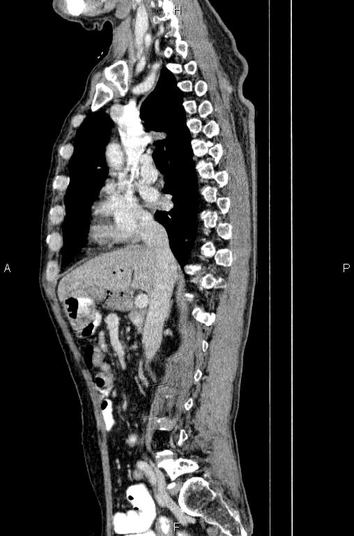 Ampullary adenocarcinoma (Radiopaedia 86093-102033 E 38).jpg