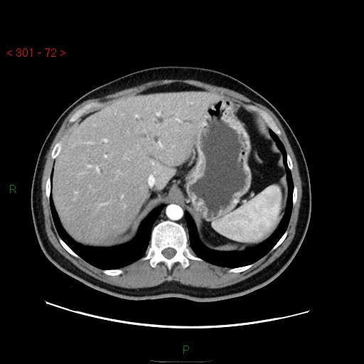 File:Ampullary carcinoma (Radiopaedia 56396-63056 B 18).jpg