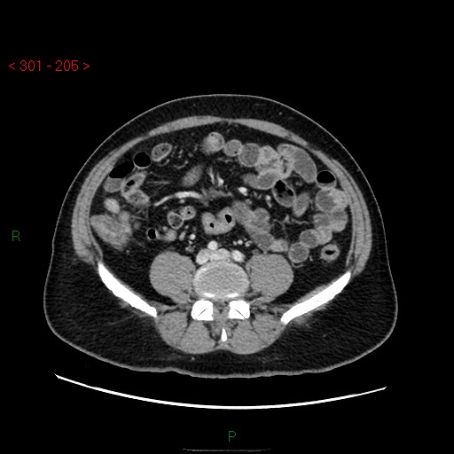 Ampullary carcinoma (Radiopaedia 56396-63056 C 64).jpg
