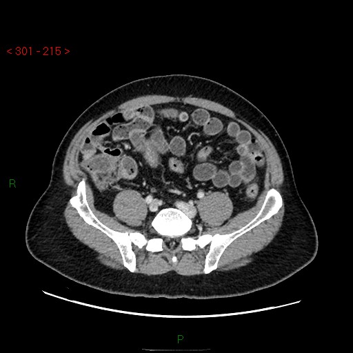 File:Ampullary carcinoma (Radiopaedia 56396-63056 C 71).jpg