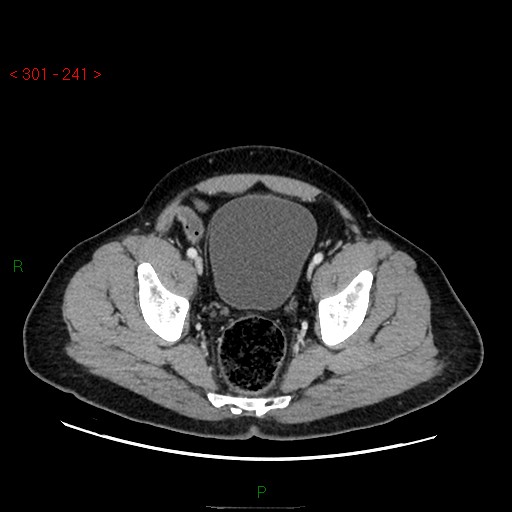 Ampullary carcinoma (Radiopaedia 56396-63056 C 88).jpg