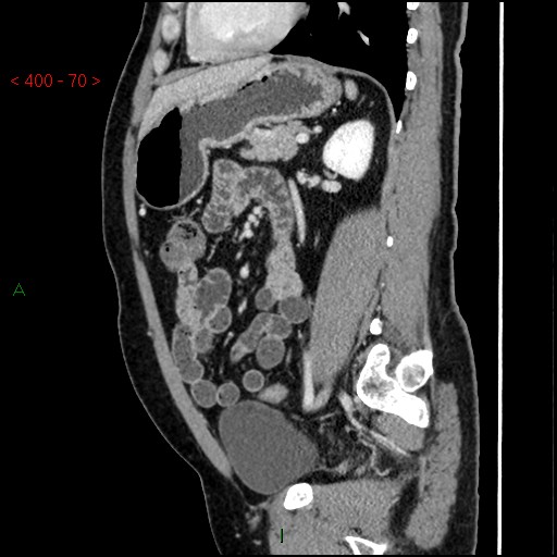 Ampullary carcinoma (Radiopaedia 56396-63056 D 69).jpg