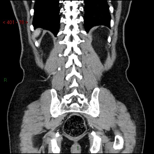 Ampullary carcinoma (Radiopaedia 56396-63056 E 77).jpg
