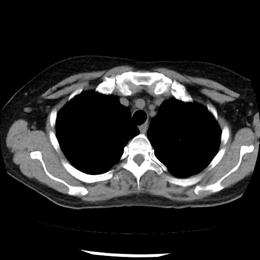 Amyloidosis - bronchial and diffuse nodular pulmonary involvement (Radiopaedia 60156-67744 Axial non-contrast 13).jpg