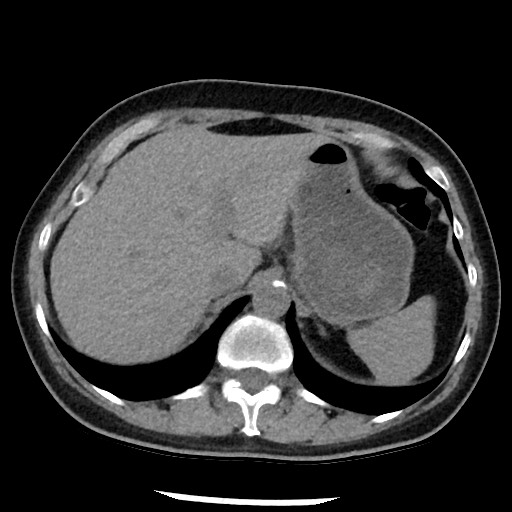 Amyloidosis - bronchial and diffuse nodular pulmonary involvement (Radiopaedia 60156-67744 Axial non-contrast 53).jpg