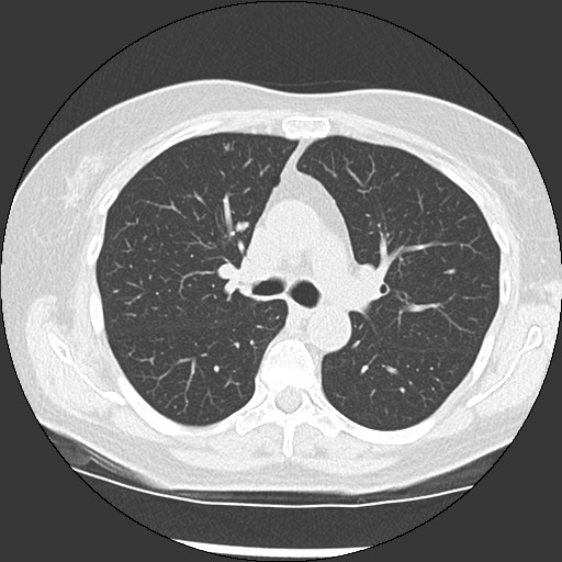 Amyloidosis - bronchial and diffuse nodular pulmonary involvement (Radiopaedia 60156-67744 B 23).jpg