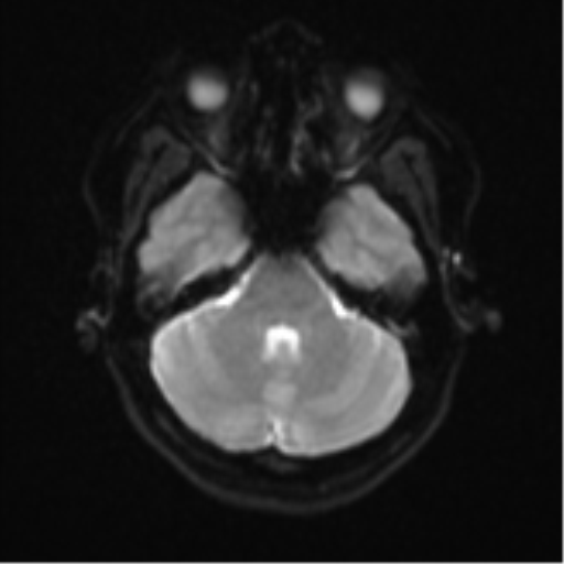 File:Anaplastic astroblastoma (Radiopaedia 55666-62194 Axial DWI 8).png