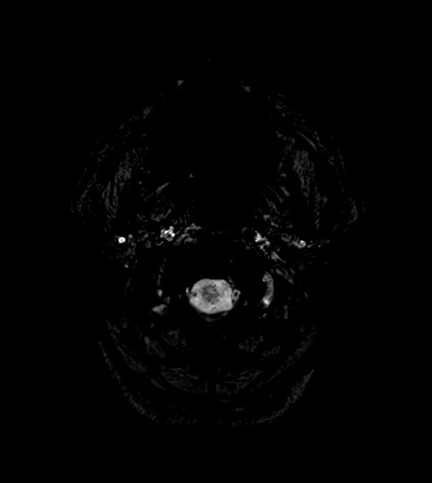 Anaplastic oligodendroglioma (Radiopaedia 79571-92754 F 2).jpg