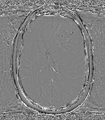 Anaplastic oligodendroglioma (Radiopaedia 83500-98599 Axial SWI - phase 49).png