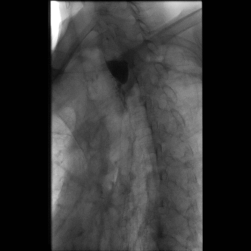 File:Anastomotic stricture post Ivor Lewis esophagectomy (Radiopaedia 47937-52715 Oblique 7).png
