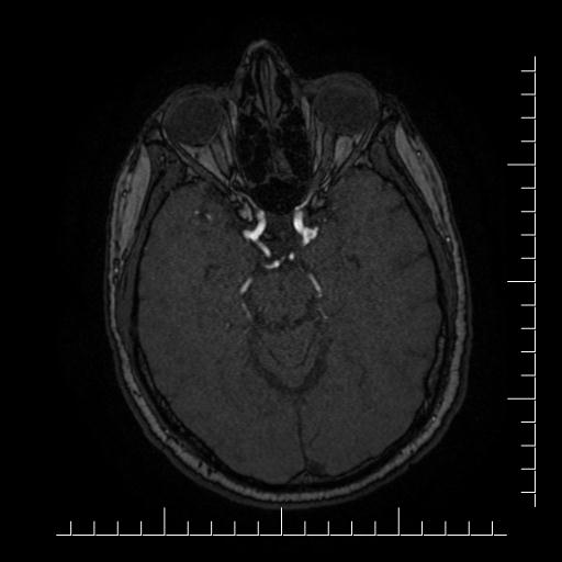 File:Aneurysm of posterior communicating artery (Radiopaedia 20188-20163 Axial MRA 31).jpg