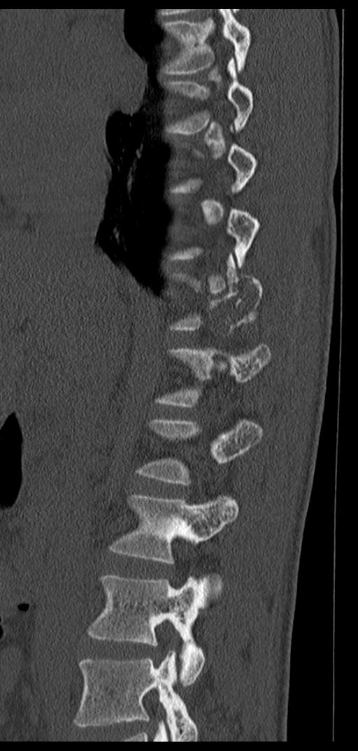 Aneurysmal bone cyst T11 (Radiopaedia 29294-29721 Sagittal bone window 51).jpg
