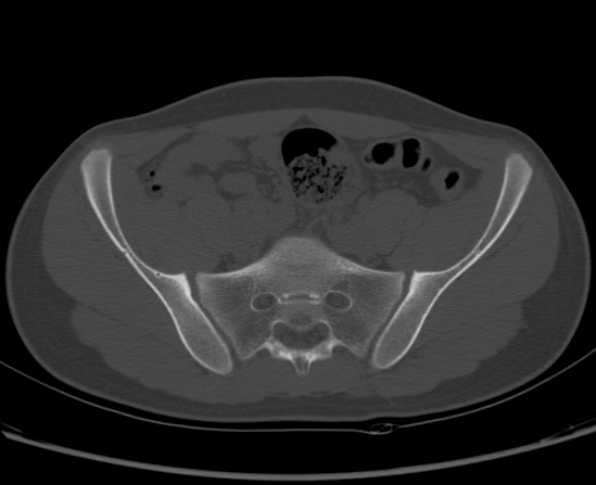 File:Aneurysmal bone cyst of ischium (Radiopaedia 25957-26094 Axial bone window 24).png