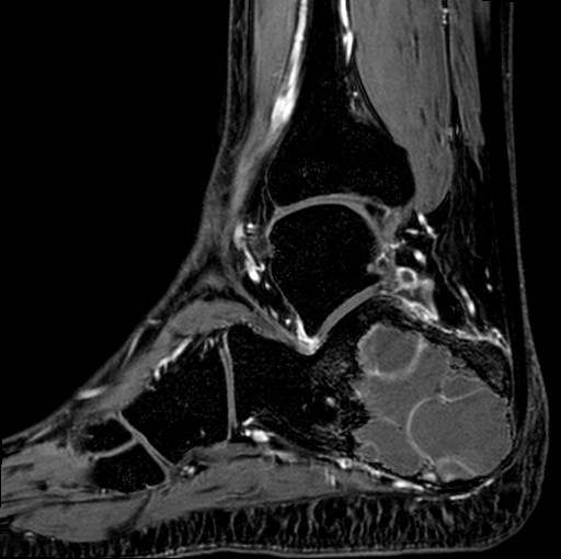 File:Aneurysmal bone cyst of the calcaneus (Radiopaedia 60669-68420 F 14).jpg