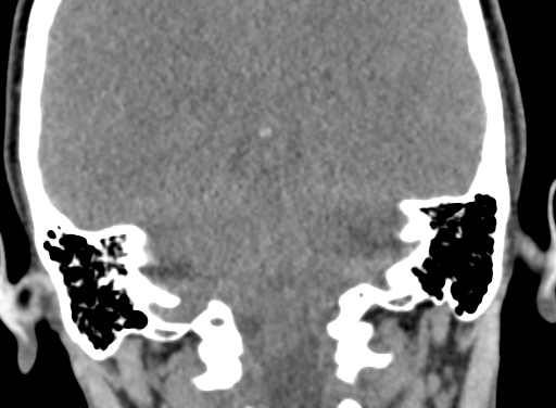 Angular dermoid cyst (Radiopaedia 88967-105790 Coronal non-contrast 87).jpg