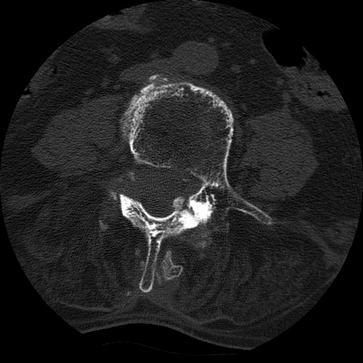 File:Ankylosing spondylitis complicated by fracture-dislocation (Radiopaedia 33583-34674 Axial non-contrast 101).jpg