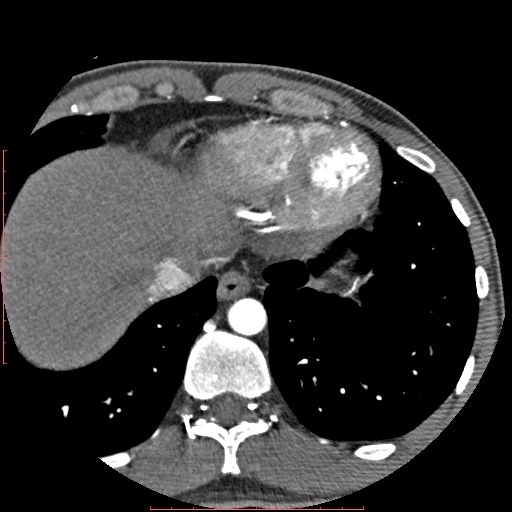 Anomalous left coronary artery from the pulmonary artery (ALCAPA) (Radiopaedia 70148-80181 A 347).jpg