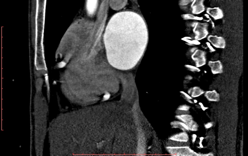 Anomalous left coronary artery from the pulmonary artery (ALCAPA) (Radiopaedia 70148-80181 C 67).jpg