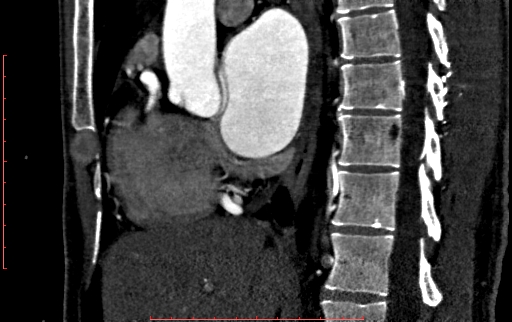 File:Anomalous left coronary artery from the pulmonary artery (ALCAPA) (Radiopaedia 70148-80181 C 97).jpg