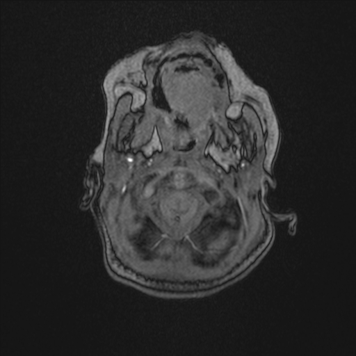 Anoxic brain injury (Radiopaedia 79165-92139 Axial MRA 16).jpg