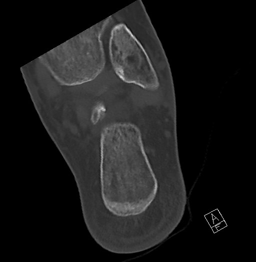 File:Anterior calcaneal process fracture (Radiopaedia 63353-71943 Axial bone window 114).jpg