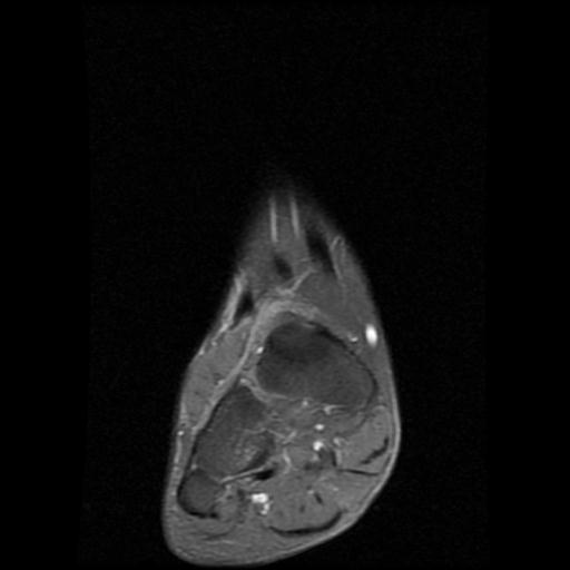 File:Anterior calcaneal process fracture (Radiopaedia 71377-81705 Coronal PD fat sat 1).jpg