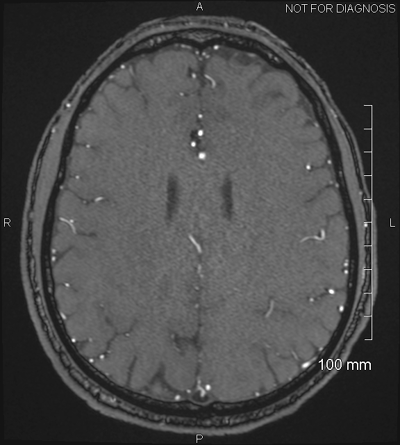 Anterior cerebral artery aneurysm (Radiopaedia 80683-94127 Axial MRA 169).jpg