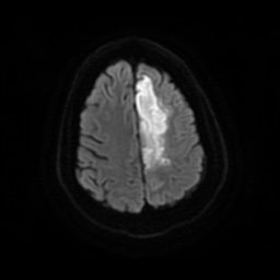 Anterior cerebral artery infarction (Radiopaedia 46794-51323 Axial DWI 22).jpg