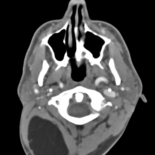 File:Anterior cerebral artery territory infarct (Radiopaedia 39327-41581 B 56).png