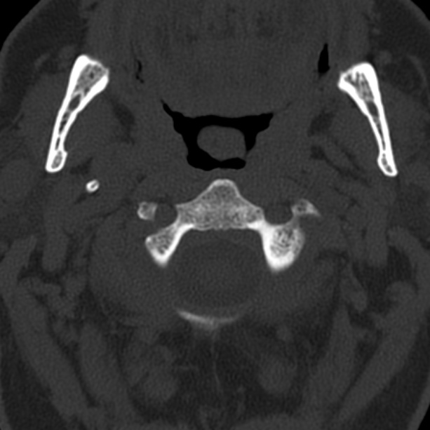 Anterior cervical postdiscectomy arthrodesis (Radiopaedia 32678-33646 Axial bone window 19).jpg