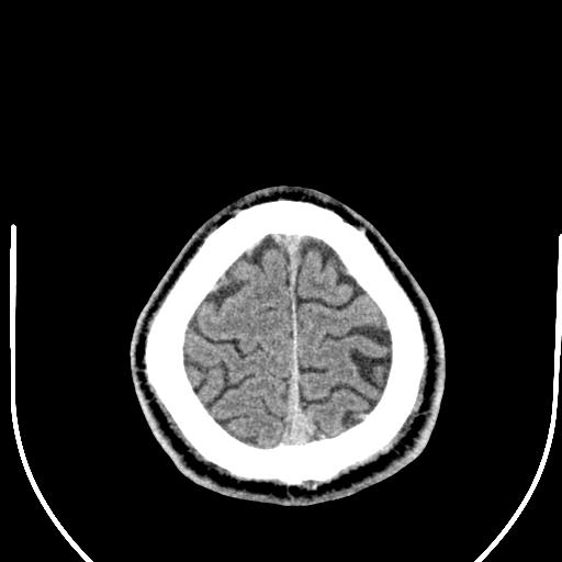 Anterior choroidal artery infarct (Radiopaedia 55106-61480 Axial non-contrast 57).jpg
