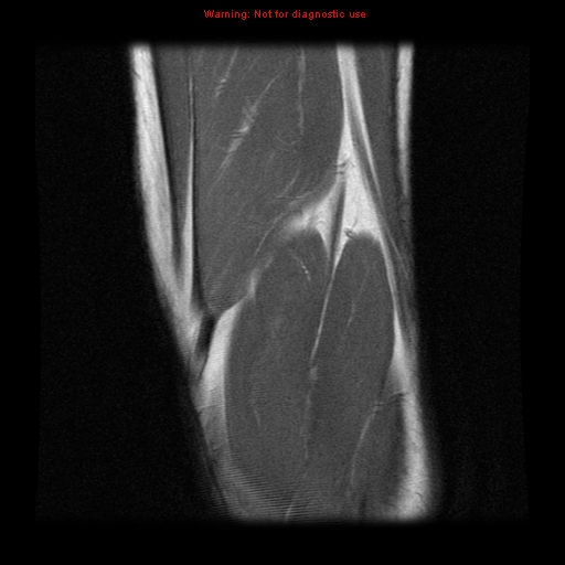File:Anterior cruciate ligament injury - partial thickness tear (Radiopaedia 12176-12515 Coronal PD 20).jpg