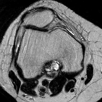 File:Anterior cruciate ligament mucoid degeneration (Radiopaedia 60853-68633 Axial T2 20).jpg