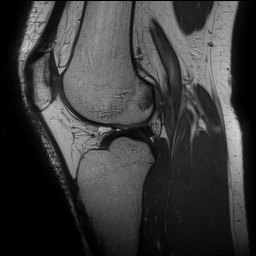 Anterior cruciate ligament rupture and posteromedial corner injury (Radiopaedia 67338-76723 Sagittal PD 101).jpg