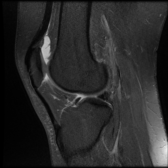File:Anterior cruciate ligament tear, Wrisberg rip and bucket-handle tear of medial meniscus (Radiopaedia 75872-87266 Sagittal PD fat sat 10).jpg