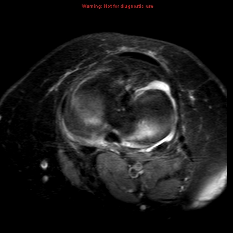File:Anterior cruciate ligament tear (Radiopaedia 12329-12612 Axial T2 fat sat 8).jpg