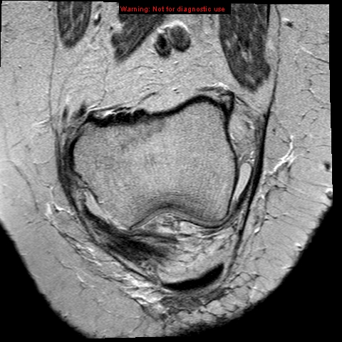 File:Anterior cruciate ligament tear (Radiopaedia 12329-12612 C 1).jpg
