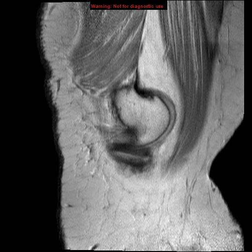 File:Anterior cruciate ligament tear - complete (Radiopaedia 12175-12514 Sagittal PD 19).jpg
