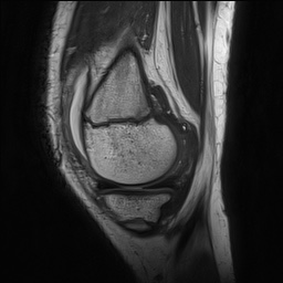 Anterior cruciate ligament tear - pediatric (Radiopaedia 62152-70260 Sagittal PD 45).jpg