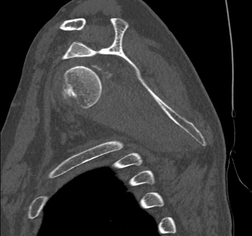 File:Anterior glenohumeral dislocation with Hill-Sachs lesion (Radiopaedia 62877-71249 Sagittal bone window 39).jpg
