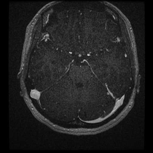 Anterior inferior cerebellar artery vascular loop - type II (Radiopaedia 70991-81209 Axial T1 C+ 6).jpg