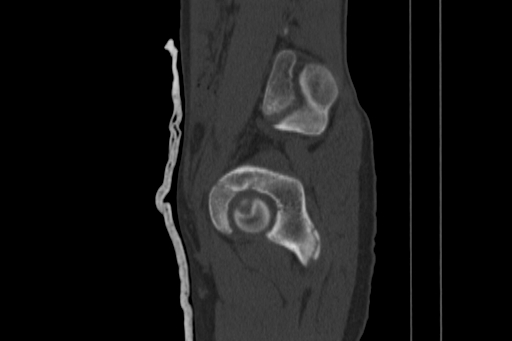 Anterior inferior iliac spine avulsion injury (Radiopaedia 88666-105376 Sagittal bone window 34).jpg