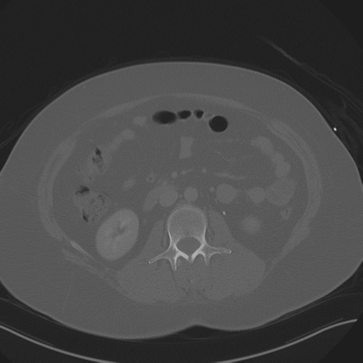 Anterior superior iliac spine avulsion fracture (Radiopaedia 44541-48244 Axial bone window 47).png