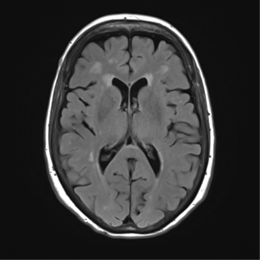 File:Anterior temporal pole cysts (Radiopaedia 46629-51102 Axial FLAIR 15).png