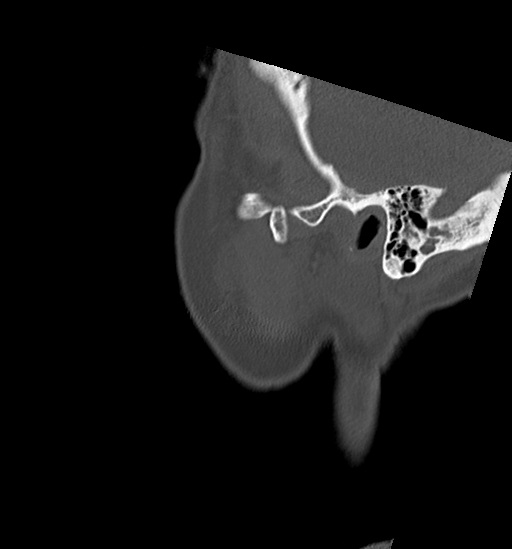 Anterior temporomandibular joint dislocation (Radiopaedia 59430-66784 B 60).jpg