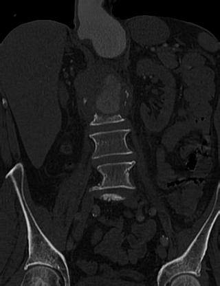 Anterior vertebral scalloping (abdominal aortic aneurysm) (Radiopaedia 66744-76067 Coronal bone window 26).jpg