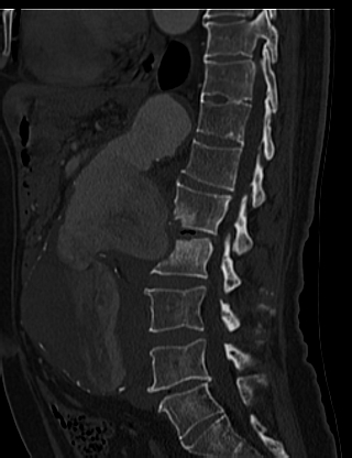 File:Anterior vertebral scalloping (abdominal aortic aneurysm) (Radiopaedia 66744-76067 Sagittal bone window 44).jpg